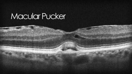 macular-pucker