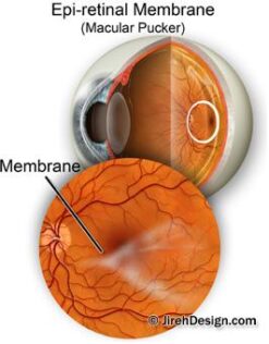 macular pucker prospects