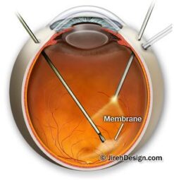 membrane Peel